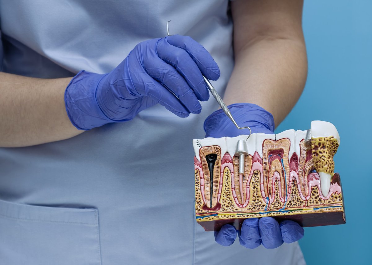 A detailed close-up of a dentist in blue gloves using a dental explorer probe to point at a tooth root on an anatomical cross-section model of the jaw.