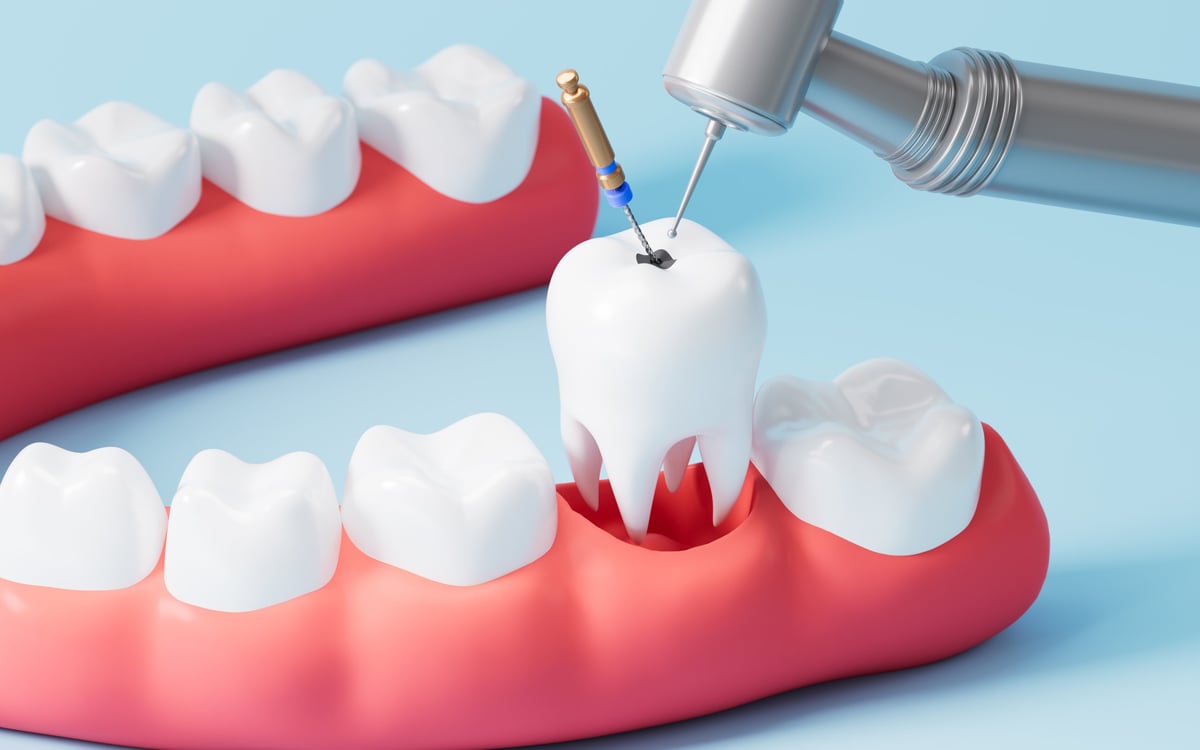 Dental treatment, filling teeth, root canal therapy, dental restoration. 3d rendering.3d illustration.