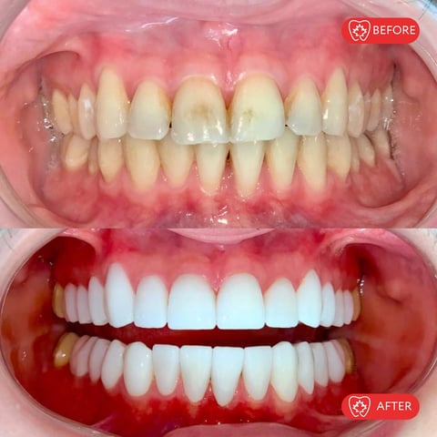 Before and after dental treatment showing yellowed teeth above transformed to bright white teeth below