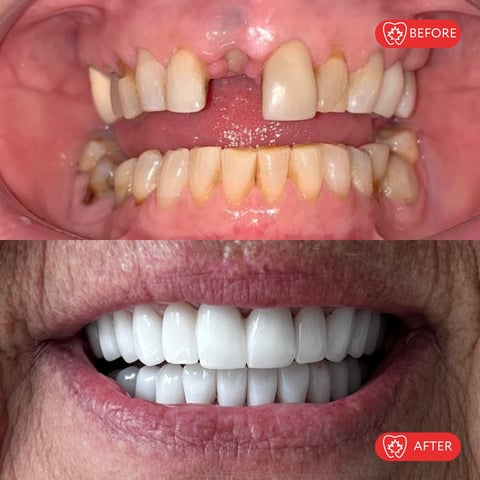 Before and after dental transformation showing discolored, damaged teeth versus a bright, uniform white smile