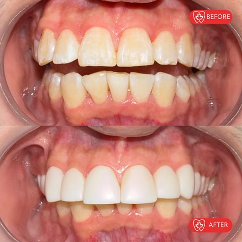 Before and after dental whitening treatment showing yellowed teeth transformed to bright white teeth