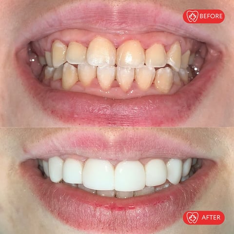 Before and after dental transformation showing yellowed, discolored teeth above and bright white teeth below