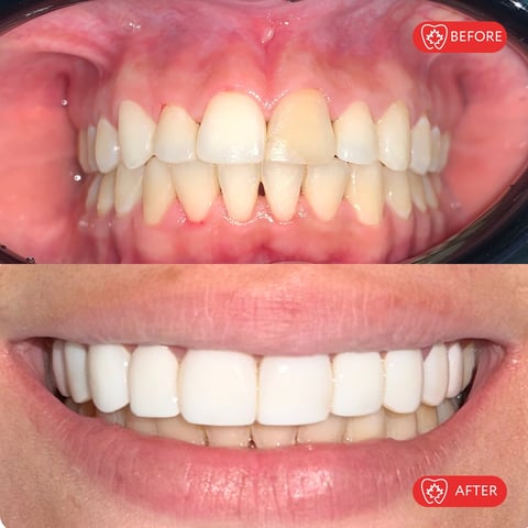 Before and after dental treatment showing improved tooth alignment and whitening results