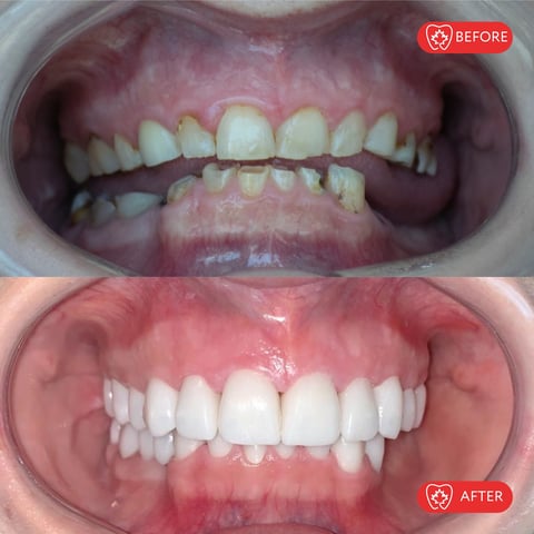 Before and after dental transformation showing discolored, misaligned teeth becoming bright white and perfectly aligned