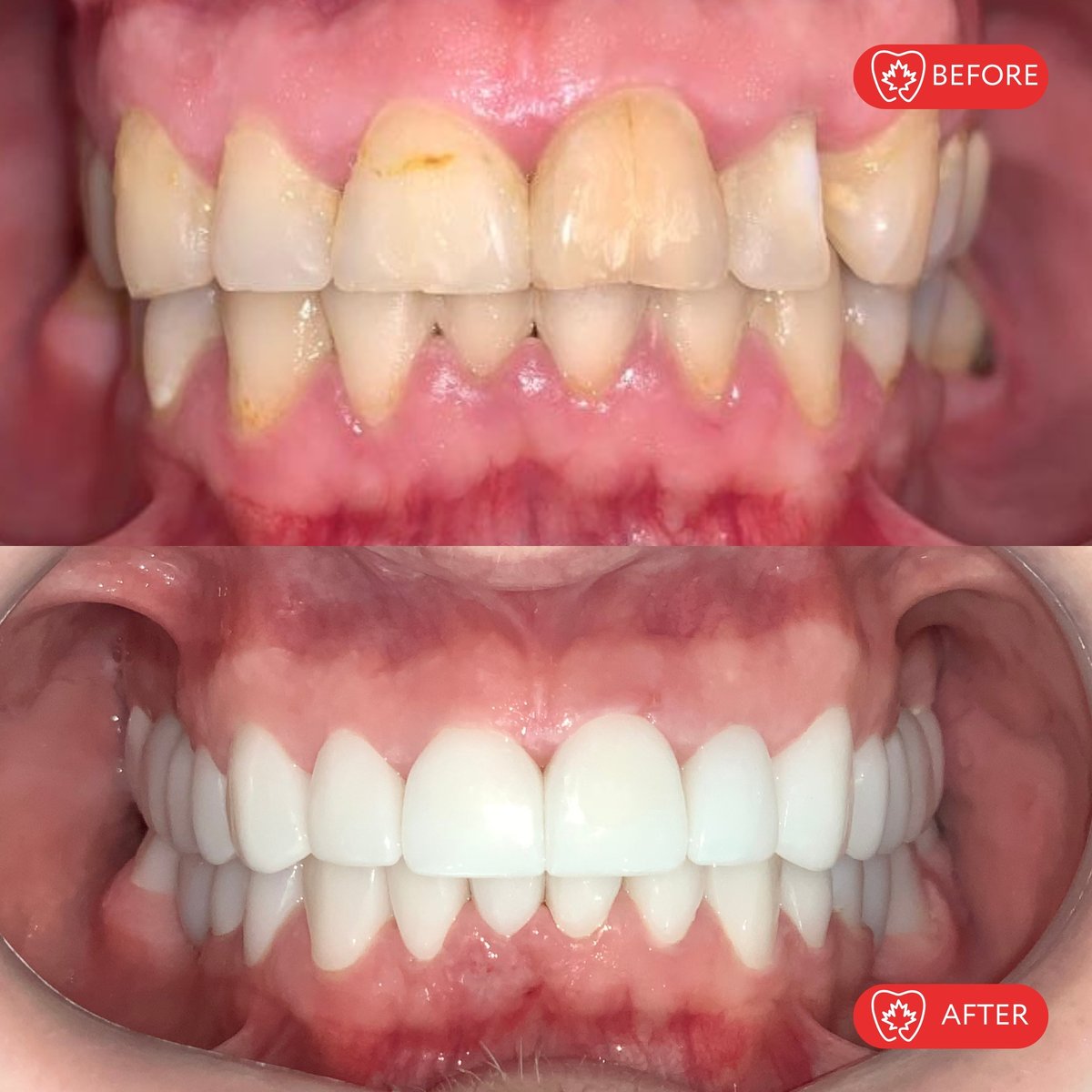 Before and after dental treatment showing discolored, worn teeth transformed to bright white, evenly aligned teeth