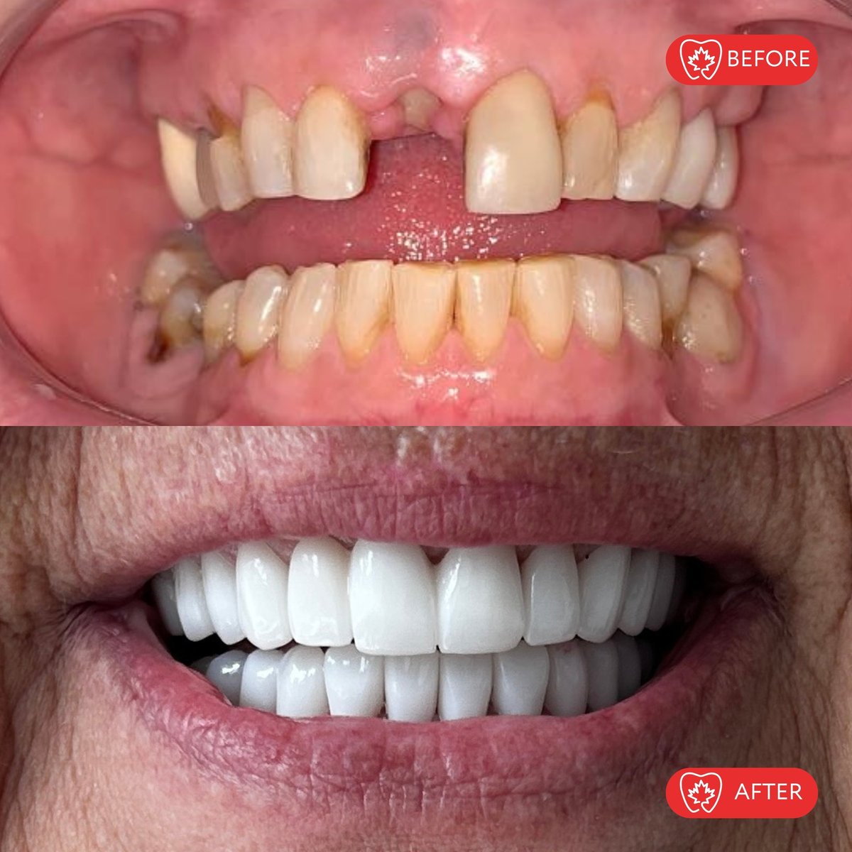 Before and after dental transformation showing discolored, spaced teeth improved to bright white, aligned teeth after cosmetic dentistry