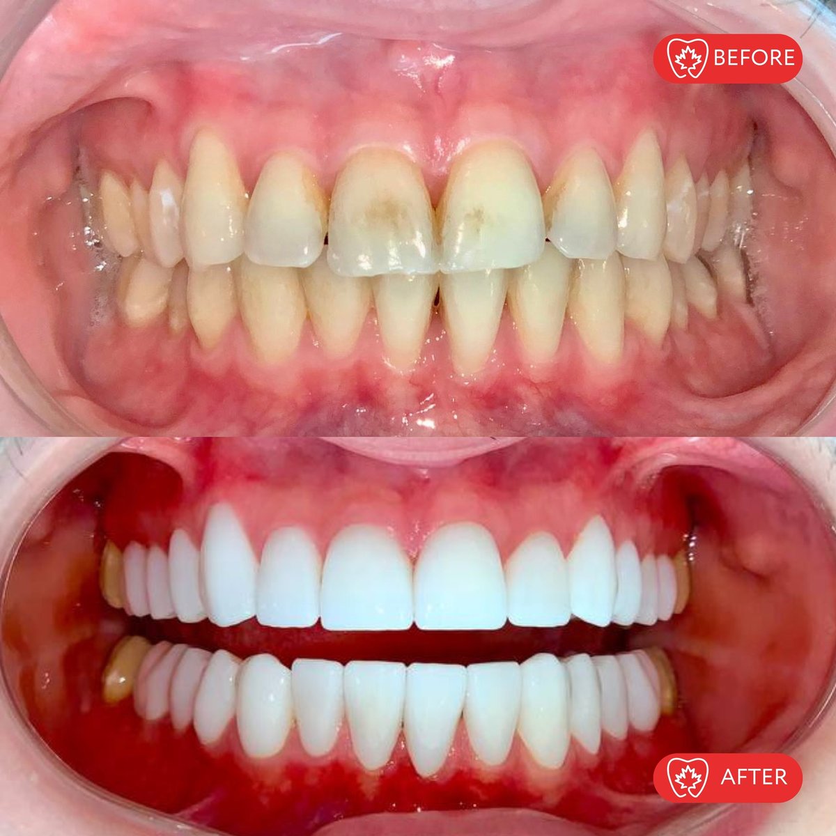 Dental transformation comparison showing before and after teeth whitening results with improved brightness and shade