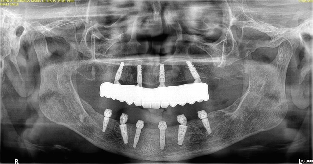 Dental panoramic X-ray showing jaw with dental implants and prosthetic teeth replacement