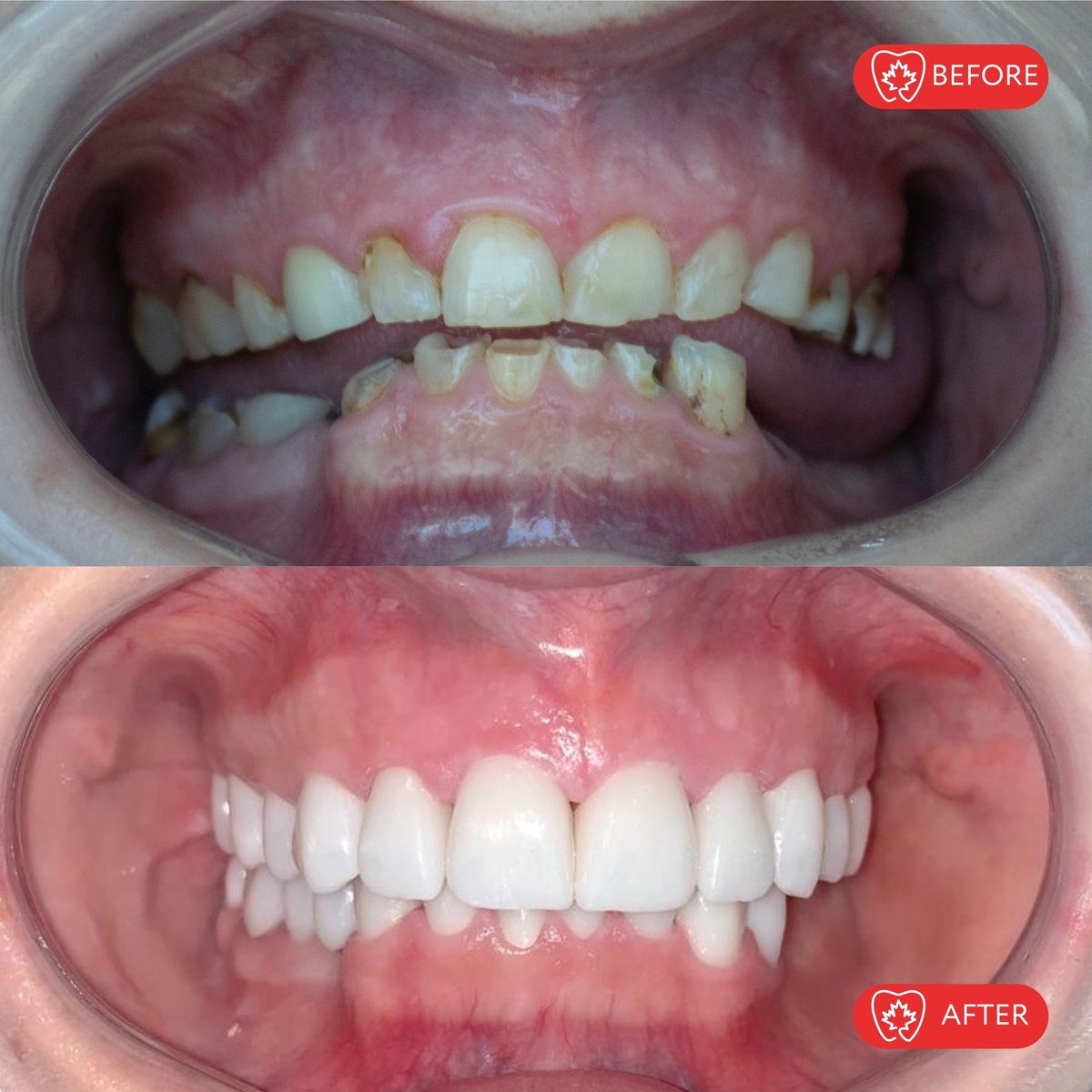 Before and after comparison of dental treatment showing improved tooth alignment and whitening