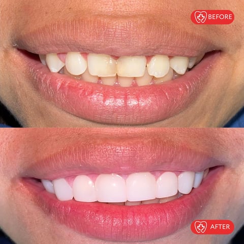 Before and after dental veneers showing improved tooth alignment and whiteness