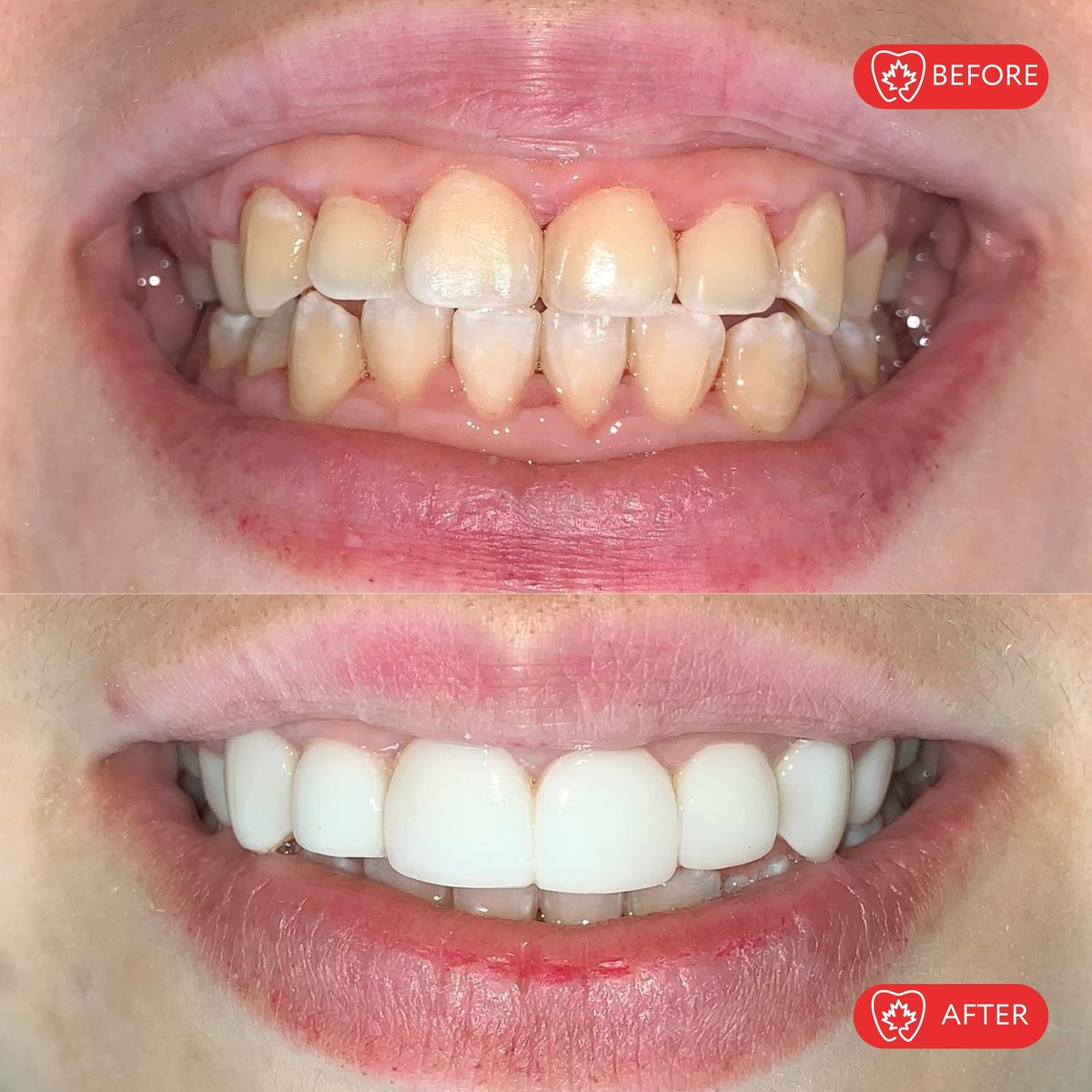 Before and after dental treatment showing discolored, misaligned teeth transformed into bright, white, evenly aligned teeth