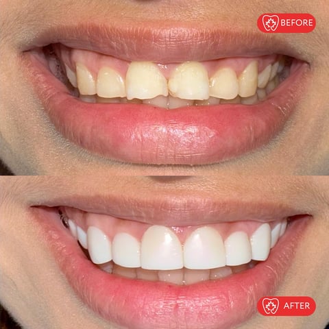 Before and after comparison of teeth whitening treatment showing improved brightness and whiteness of upper teeth