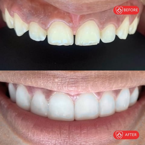 Before and after comparison of teeth whitening treatment showing improved tooth brightness and color